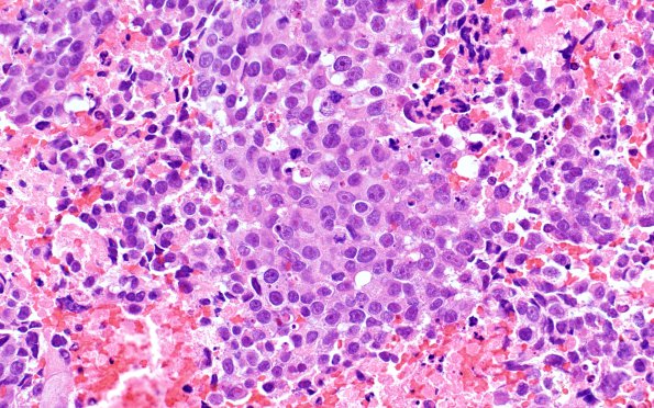 72A Metastasis, lung, squamous (Case 72) H&E 1