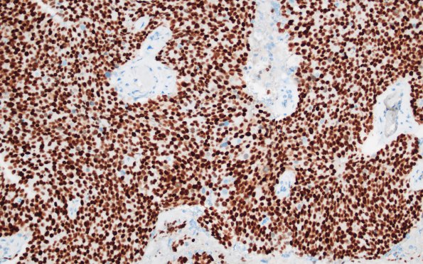 72C Metastasis, lung, squamous (Case 72) p40 1