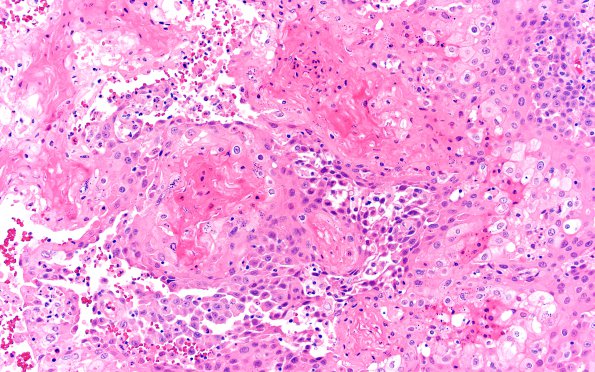 73A1 Metastasis, lung, squamous (Case 73) H&E 20X 3