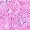 73A2 Metastasis, lung, squamous (Case 73) H&E 40X 1