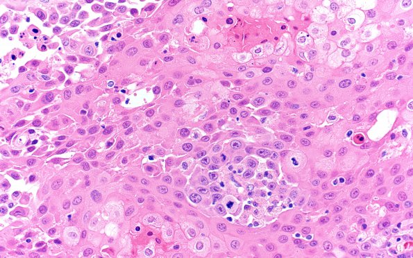 73A2 Metastasis, lung, squamous (Case 73) H&E 40X 1