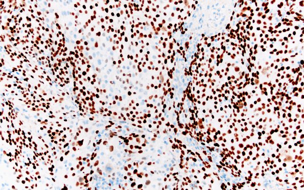 73B Metastasis, lung, squamous (Case 73) p40 20X 1