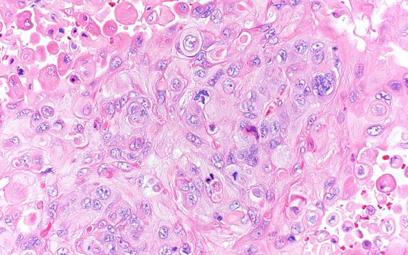 74A Metastasis, lung, squamous (Case 74) H&E 40X