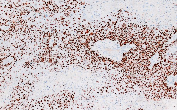 74B Metastasis, lung, squamous (Case 74) p40 10X