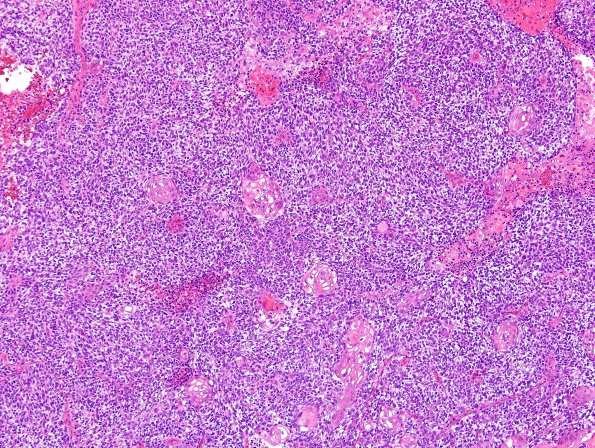 75A1 Metastasis, lung, squamous (Case 75) H&E 3.jpg