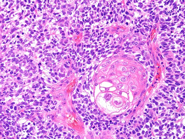 75A2 Metastasis, lung, squamous (Case 75) H&E 2.jpg