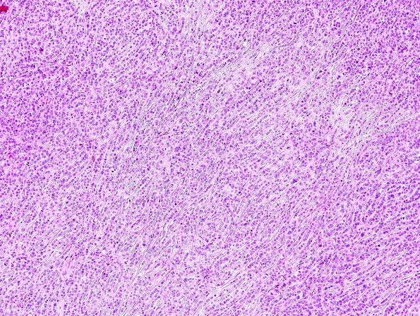 77A1 Metastasis, breast (Case 77) H&E 2.jpg