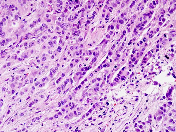 77A2 Metastasis, breast (Case 77) H&E 1.jpg