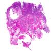 78A1 Metastasis, breast primary (Case 78) WM H&E 2