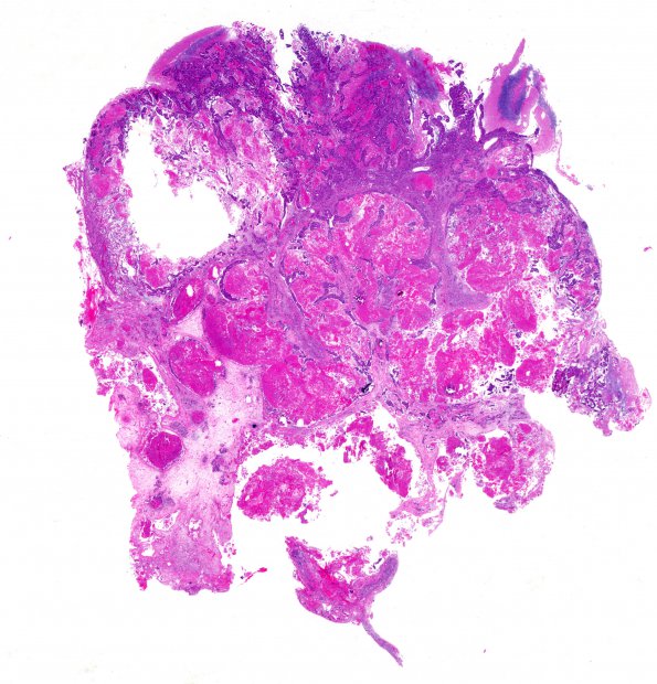 78A1 Metastasis, breast primary (Case 78) WM H&E 2