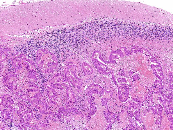 78A2 Metastasis, breast primary (Case 78) H&E 5