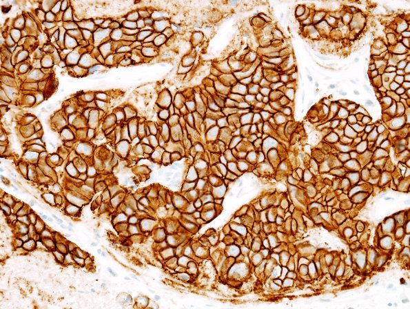 78B Metastasis, breast primary (Case 78) Her-2 1