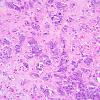 79A1 Metastatic breast ca (Case 79) 1.jpg