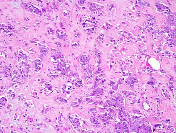 79A1 Metastatic breast ca (Case 79) 1.jpg