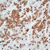 79B1 Metastatic breast ca (Case 79) Mammaglobin 1.jpg