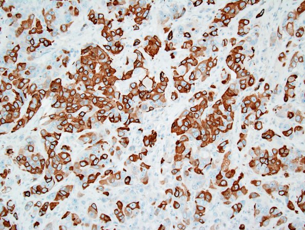 79B1 Metastatic breast ca (Case 79) Mammaglobin 1.jpg