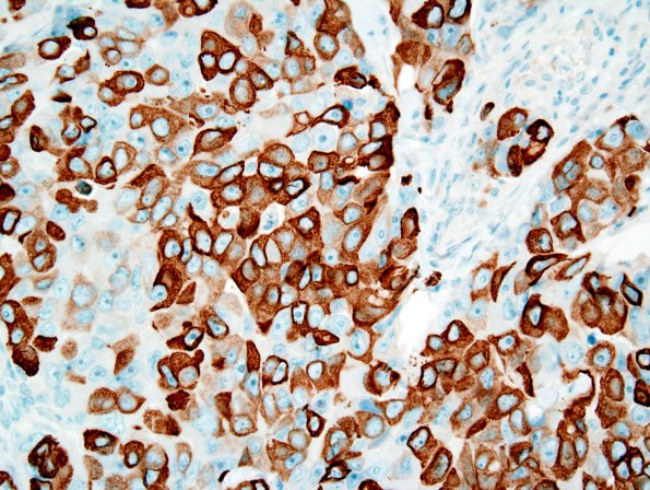 79B2 Metastatic breast ca (Case 79) Mammaglobin 2.jpg