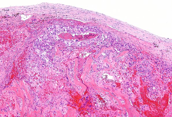 7A1 Metastasis, prostate (Case 7) H&E 3