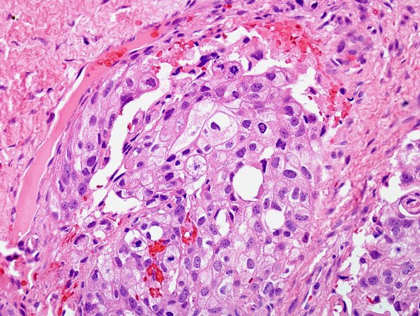 7A2 Metastasis, prostate (Case 7) H&E 2