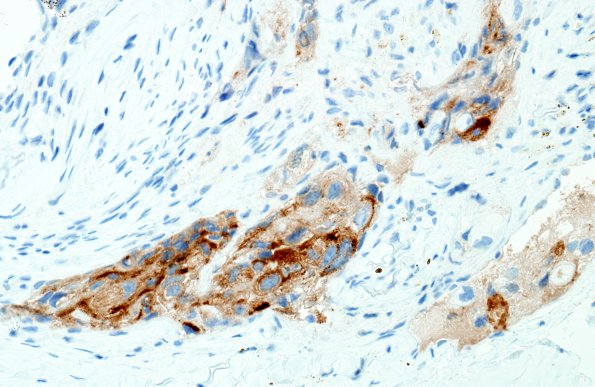 7B Metastasis, prostate (Case 7) PSA 1