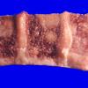 80A Metastasis, breast, spine (Case 80)