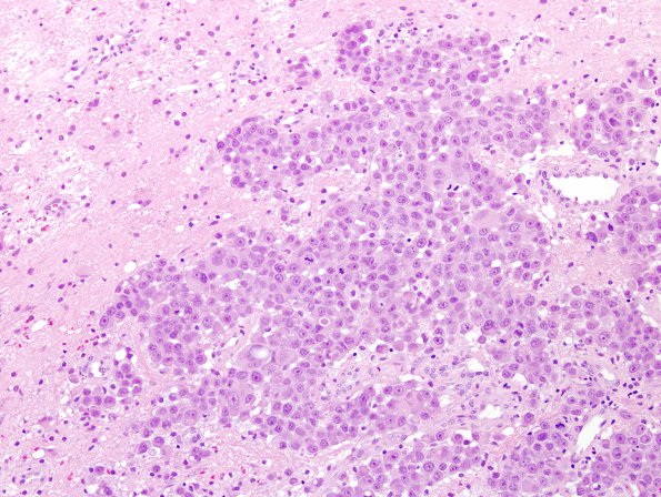 81A1 Metastases (Case 81) breast H&E 2a