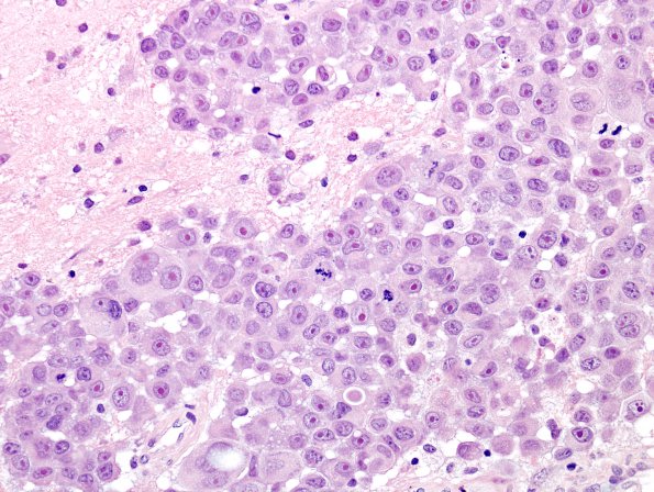 81A2 Metastases (Case 81) breast H&E 1a