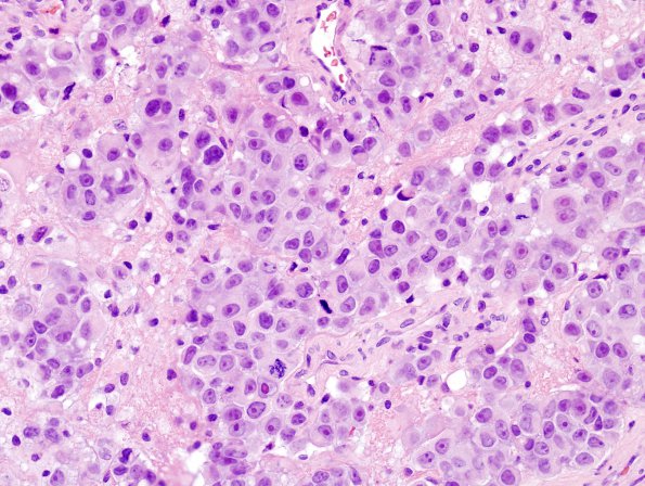 81A3 Metastases (Case 81) breast H&E 1