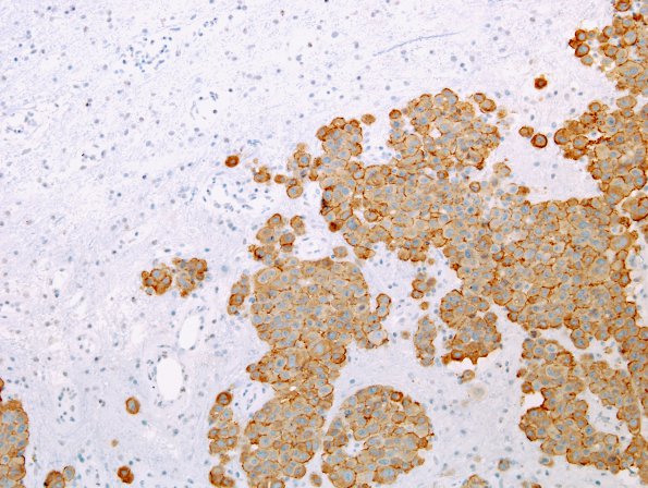 81B1 Metastases (Case 81) breast HER-2 (20X)