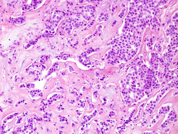 82A1 Metastases, breast (Case 82) H&E 1