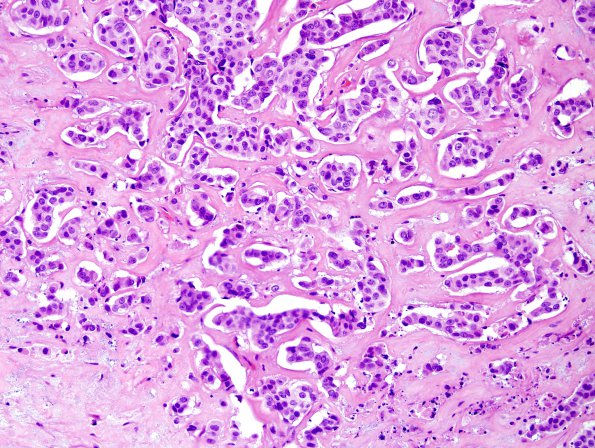 82A 2Metastases, breast (Case 82) H&E 2