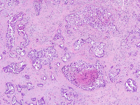 83A1 Metastases, breast (Case 83) H&E 2.jpg