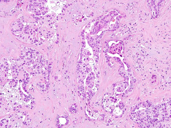 83A2 Metastases, breast (Case 83) H&E 3.jpg