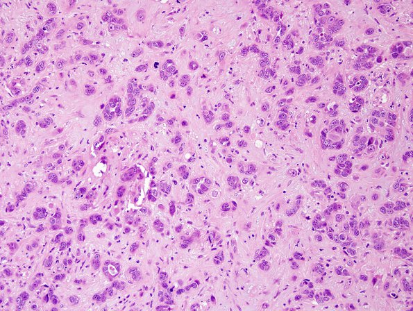 83A3 Metastases, breast (Case 83) H&E 5.jpg