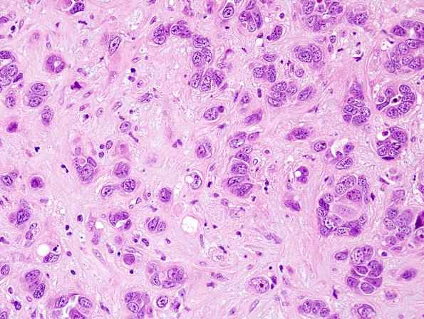 83A4 Metastases, breast (Case 83) H&E 6.jpg