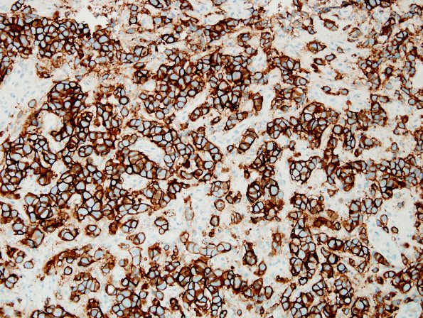 83B Metastases, breast (Case 83) HER-2.jpg