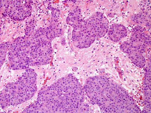 84A1 Metastasis (Case 84) breast primary H&E 4.jpg
