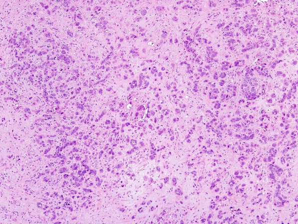 84A2 Metastases, breast (Case 84) H&E 4.jpg