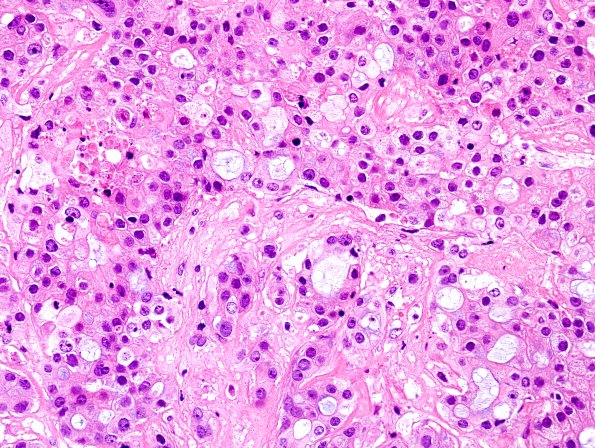 84A3 Metastasis (Case 84) breast primary H&E 2.jpg