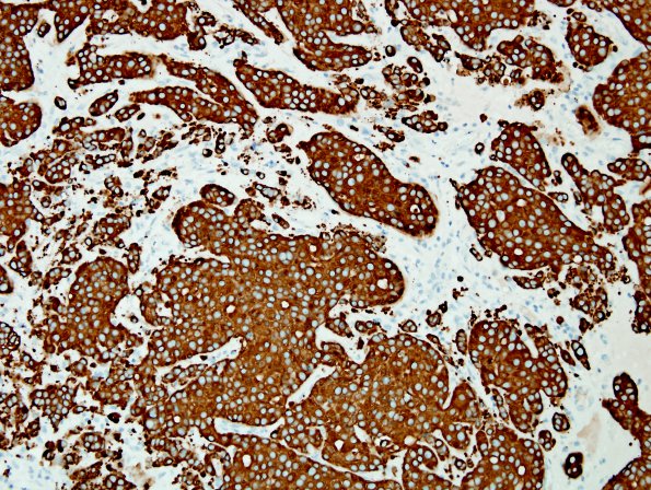 84B Metastasis (Case 84) breast primary CK7.jpg