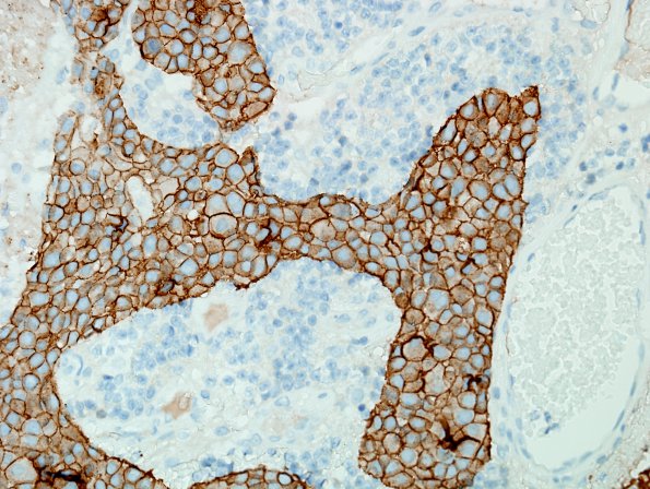 84D Metastasis (Case 84) breast primary Her2 1.jpg