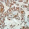 84E Metastasis (Case 84) breast primary Mammaglobin 1.jpg