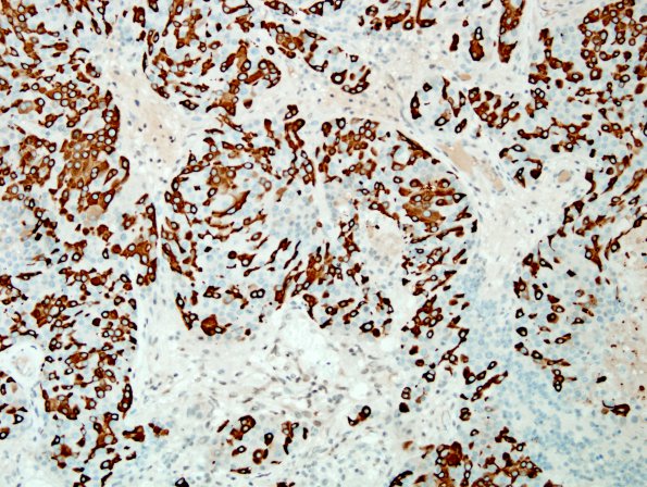 84E Metastasis (Case 84) breast primary Mammaglobin 1.jpg