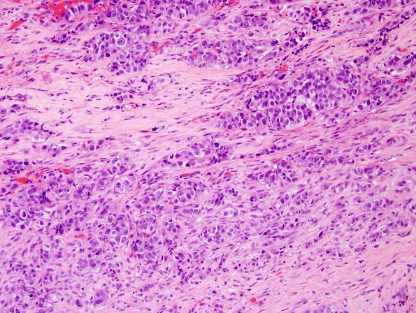 85A Metastasis, breast (Case 85) H&E 3.jpg