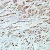 85B1 Metastasis, breast (Case 85) GATA3 2.jpg