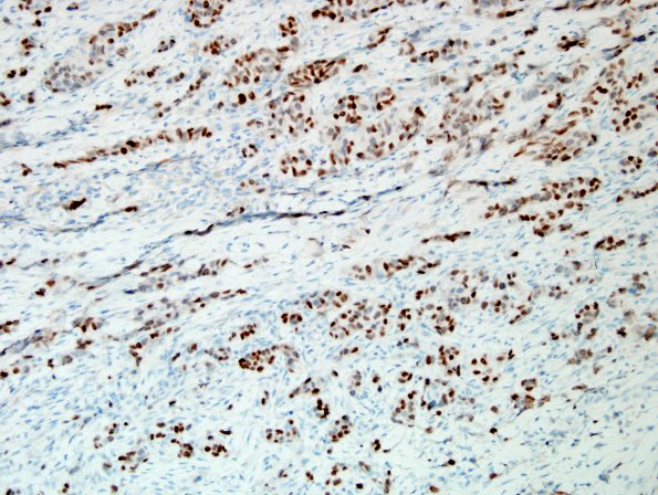 85B1 Metastasis, breast (Case 85) GATA3 2.jpg