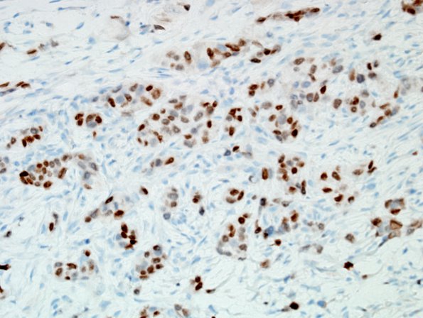 85B2 Metastasis, breast (Case 85) GATA3 1.jpg