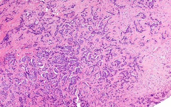 86A1 Metastasis, breast (Case 86) H&E 1