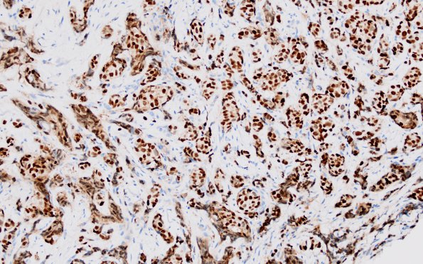 86B1 Metastasis, breast (Case 86) ER 1