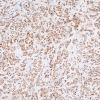 86B2 Metastasis, breast (Case 86) PR 1